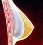 A subglandular implant is placed above the muscle.