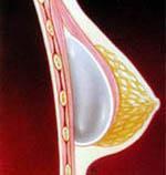 A submuscular implant is placed under the muscle.